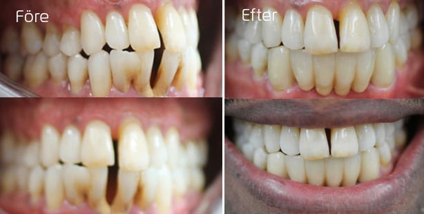 Före och efter trångställning I överkäken- behandling med tandställning Inman Eligner