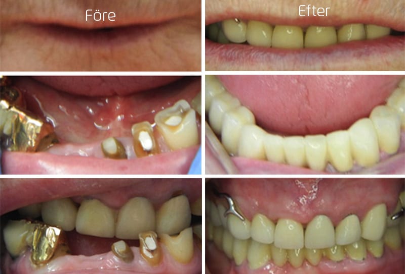 Före och efter bilder hel tandbro i underkäke, tandkronor och tandprotes i överkäke