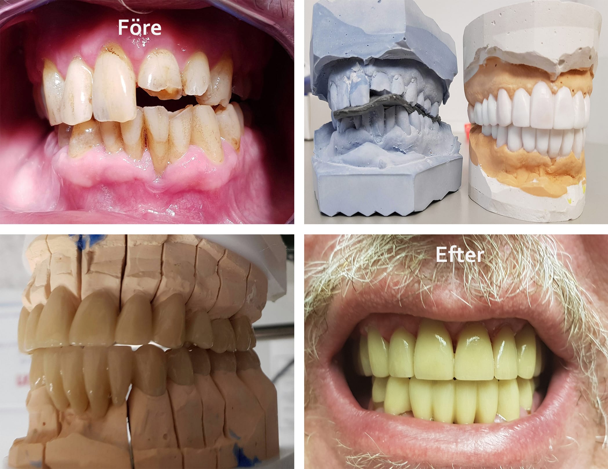 Före och efter bilder på tänder som blivit fixade